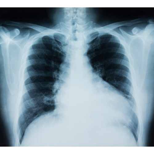 关于小细胞肺癌，你必须要了解的几个事实。
