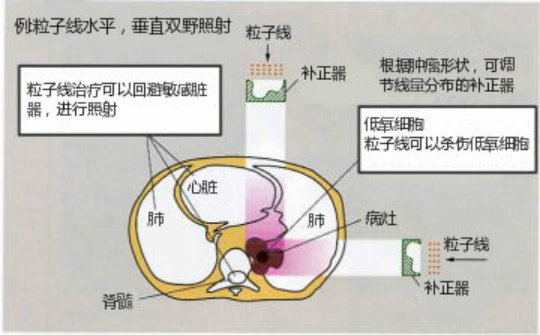 儿童横纹肌肉瘤