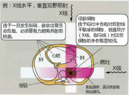 儿童横纹肌肉瘤