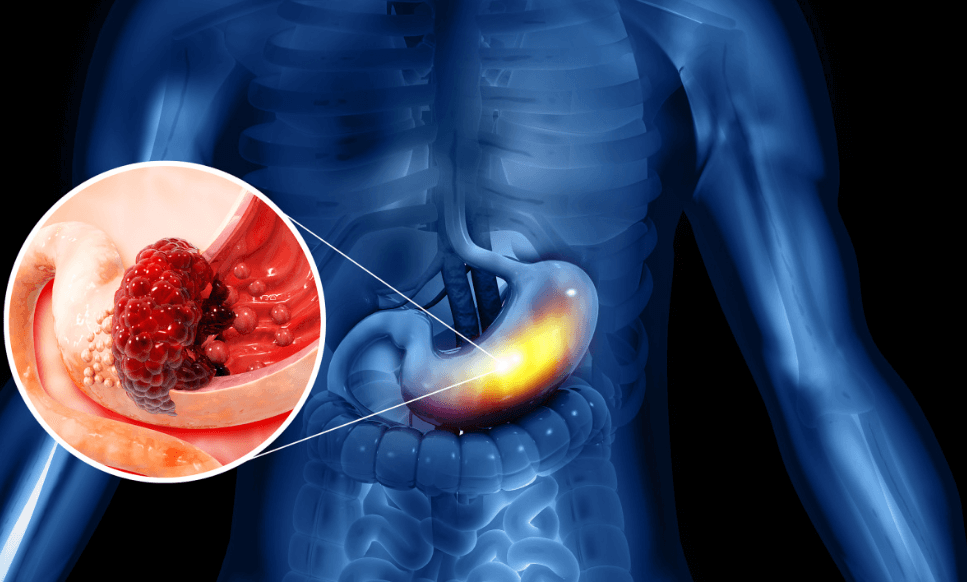 胃癌患者必看！！你需要知道的胃癌早期症状及如何预防。