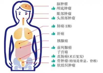 日本重离子治疗