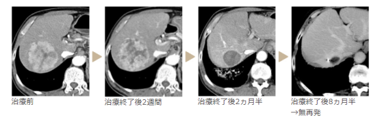 质子治疗适用于哪些癌症患者