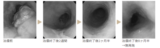 质子治疗适用于哪些癌症患者