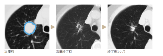 质子治疗适用于哪些癌症患者