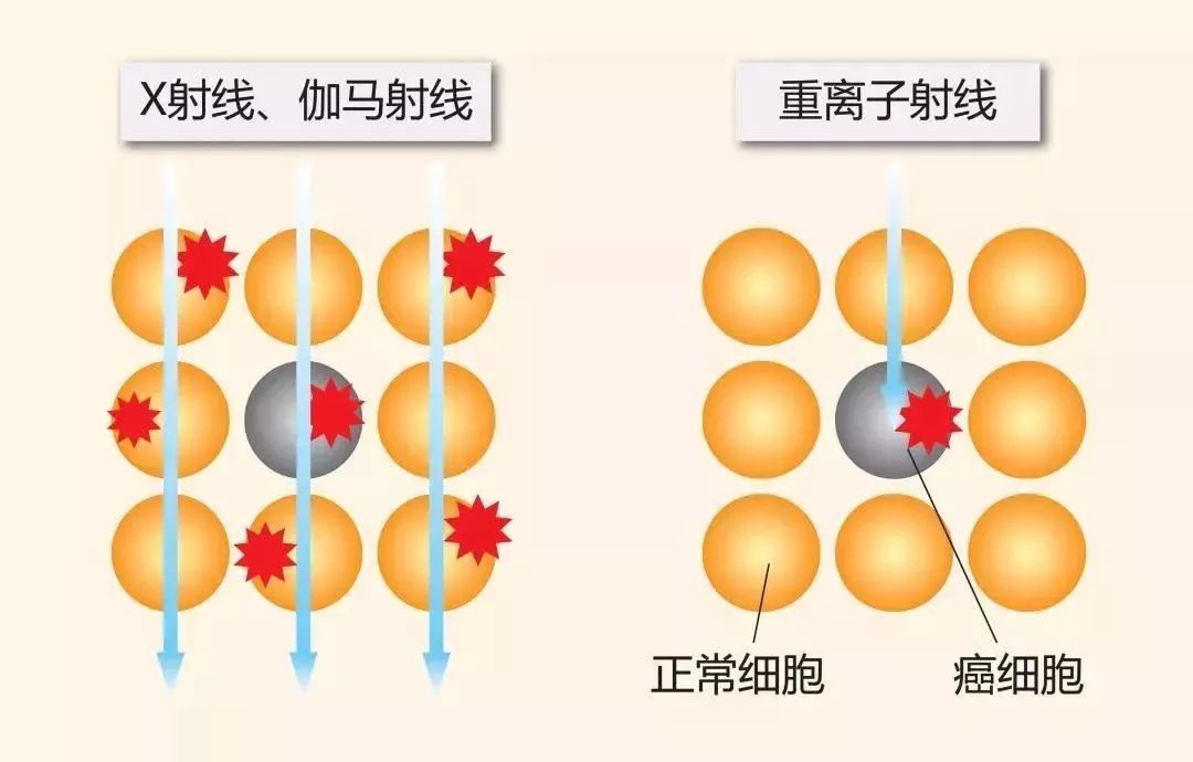 质子治疗、重离子治疗是什么？真的能治愈肿瘤吗？