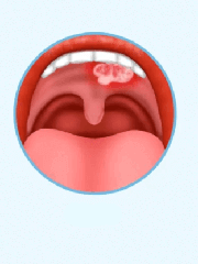 日本治疗舌癌等口腔癌优势显著，5 年生存率 高达86.6%，患者皆可受益！