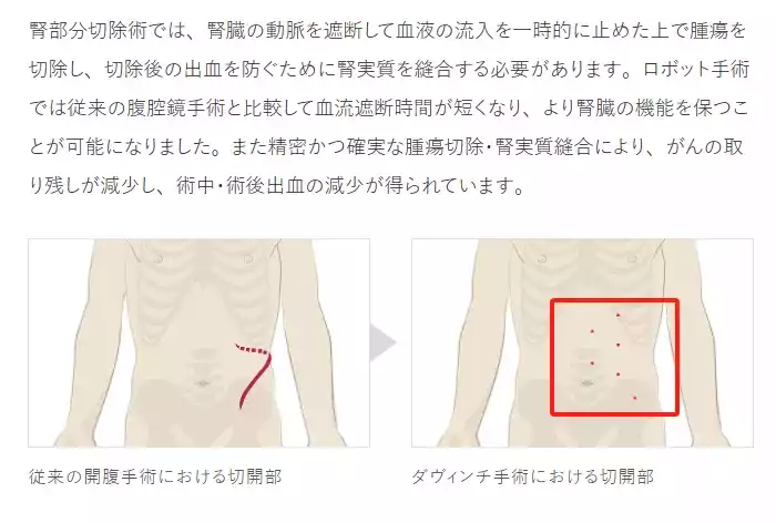 可愈有道_70岁患肾癌，日本专家采用达芬奇机器人手术为他根治性切除，仅用18 万！