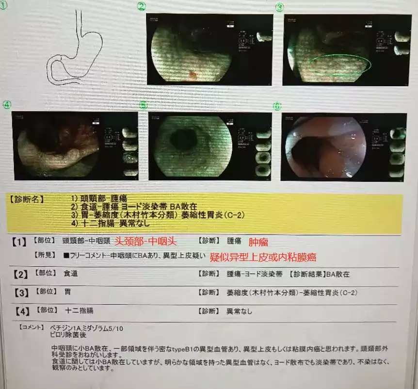 赴日精密筛查果然不一般，竟揪出早期咽喉癌！-可愈有道