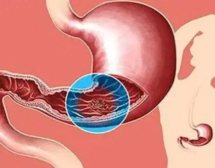 可愈有道_FDA批准zolbetuximab-clzb联合化疗用于CLDN18.2阳性胃癌和胃食管结合部腺癌患者