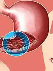 可愈有道_出国看病_FDA批准zolbetuximab-clzb联合化疗用于CLDN18.2阳性胃癌和胃食管结合部腺癌患者