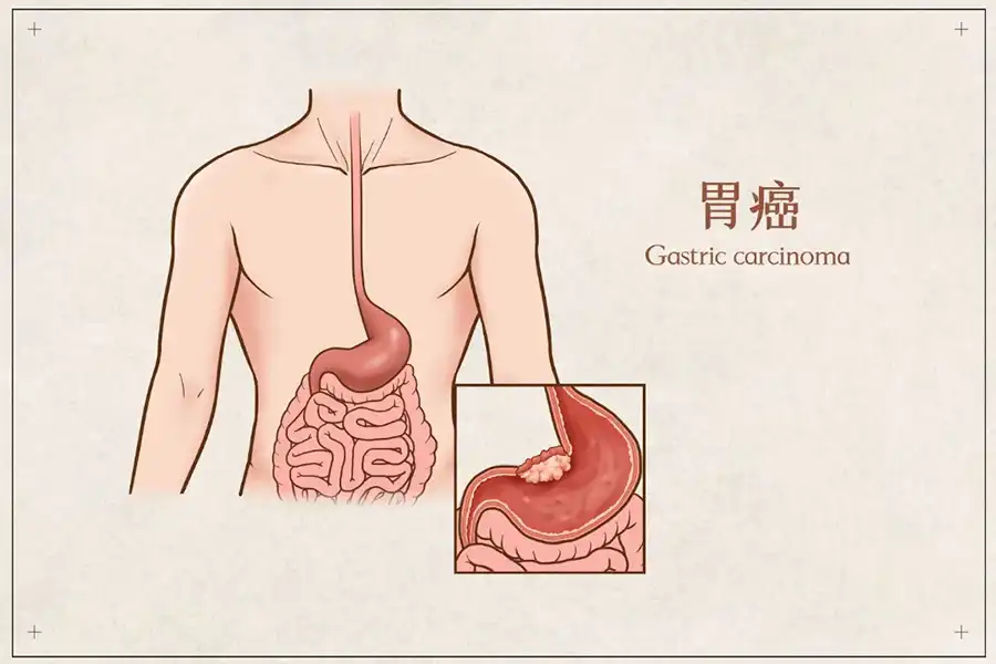 可愈有道-20岁就得了胃癌，是吃错了什么